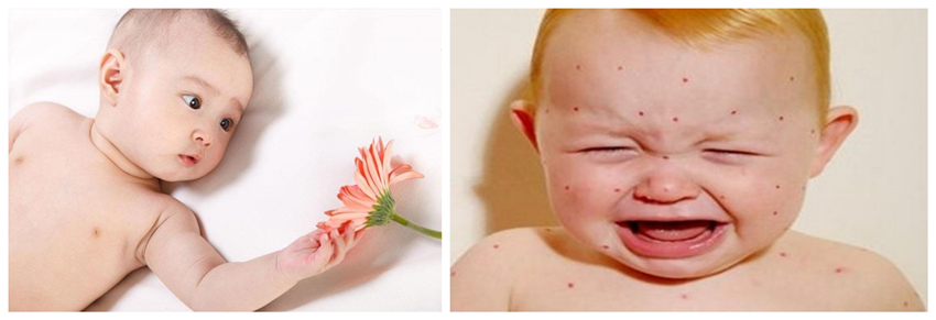 兒童濕疹反反復(fù)復(fù)，您有在家安裝家用除濕產(chǎn)品嗎？